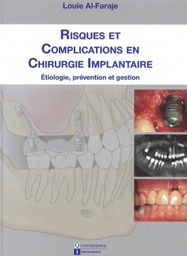 Louie Al-Faraje - Risques et complications en chirurgie implantaire - Etiologie, prévention et gestion.