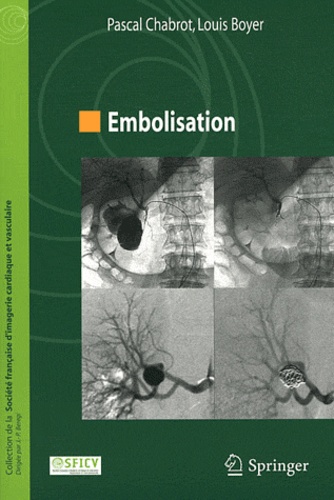 Louis Boyer et Pascal Chabrot - Embolisation.