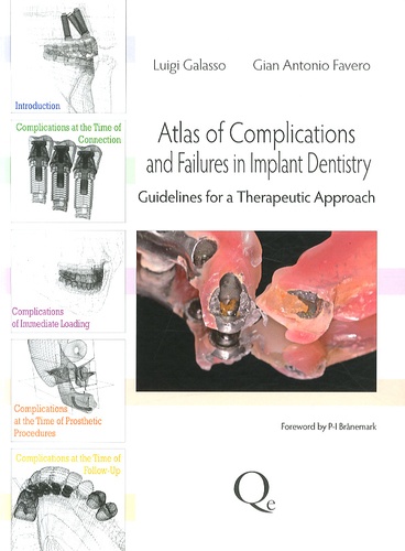 Luigi Galasso et Gian Antonio Favero - Atlas of complications and failures in implant dentistry - Guidelines for a therapeutic approach.