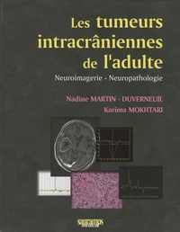 Les tumeurs intracrâniennes de l'adulte à l'exclusion de la base du crâne et de la région hypophysaire
