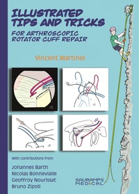 Illustrated tips & tricks for arthroscopic rotator cuff repair