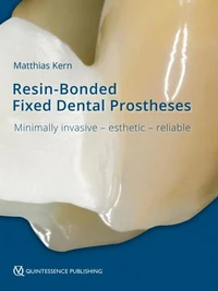 RBFDPs - Resin-Bonded Fixed Dental Prostheses