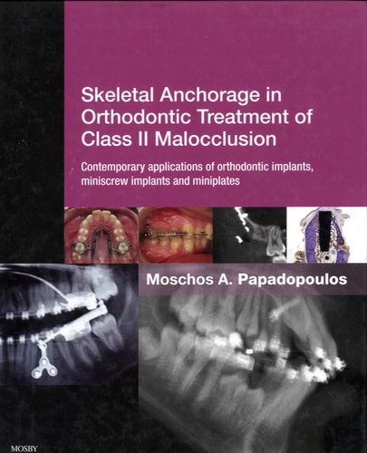 Moschos Papadopoulos - Skeletal Anchorage in Orthodontic Treatment of Class II Malocclusion - Contemporary Applications of Orthodontic Implants, Miniscrew Implants and Miniplates.