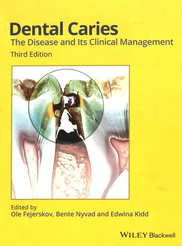 Ole Fejerskov et Bente Nyvad - Dental Caries - The Disease and its Clinical Management.