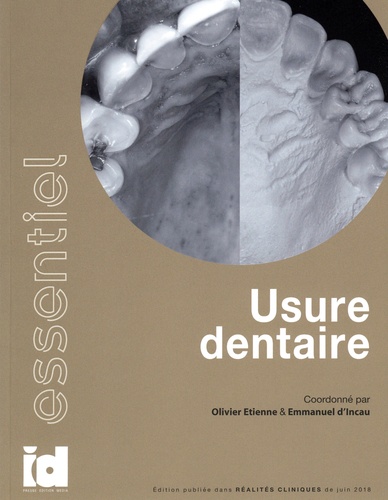 Usure dentaire