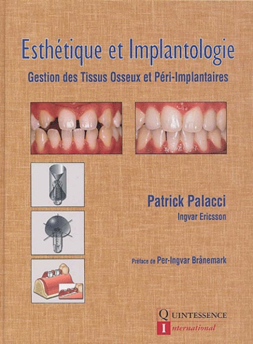 Patrick Palacci - Esthetique Et Implantologie. Gestion Des Tissus Osseux Et Peri-Implantaires.