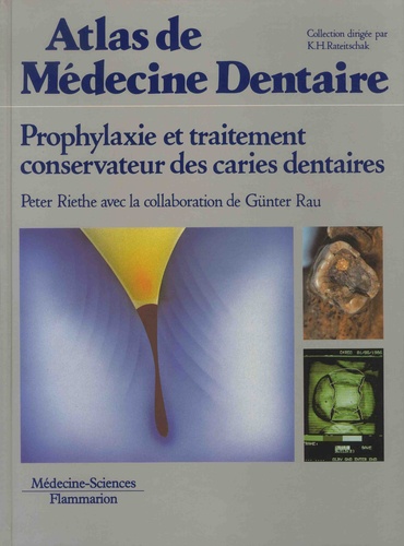 Peter Riethe et Gunter Rau - Prophylaxie et traitement conservateur des caries dentaires.