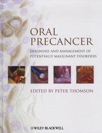 Peter Thomson - Oral Precancer - Diagnosis and Management of Potentially Malignant Disorders.