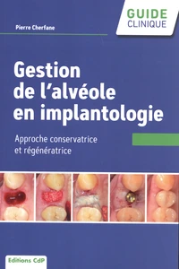 L'alvéole en implantologie