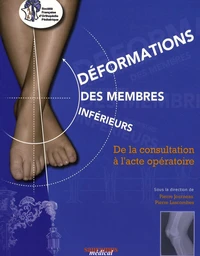 Déformations des membres inférieurs