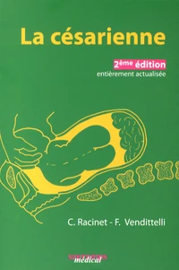 La césarienne