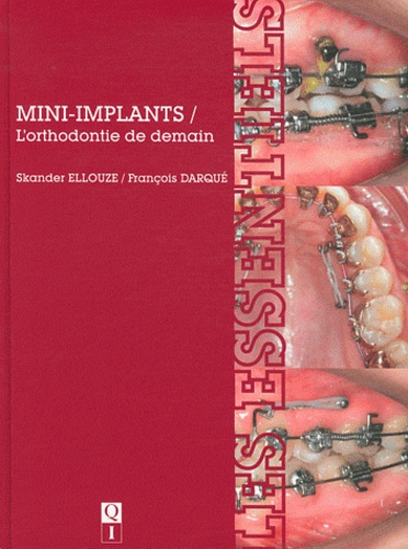 Skander Ellouze et François Darqué - Mini-implants - L'orthodontie de demain.