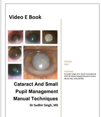  Sudhir Singh - Cataract And Small Pupil Management Manual Techniques - 2022, #1.