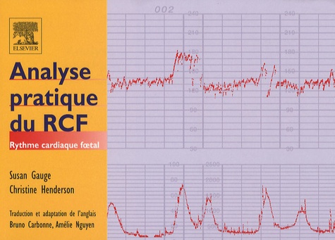 Analyse pratique du RCF. Rythme cardiaque foetal