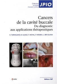 Les cancers de la cavité buccale